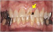 前歯の歯冠破折