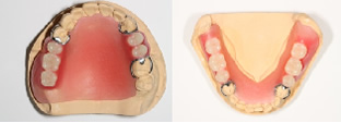 人工歯を並べて、歯の並び、噛み合わせ、色などを確認します