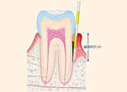 歯周病（歯槽膿漏）