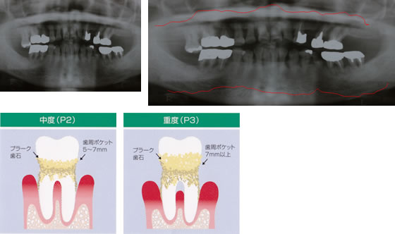 重度の歯周病の方の骨の状態